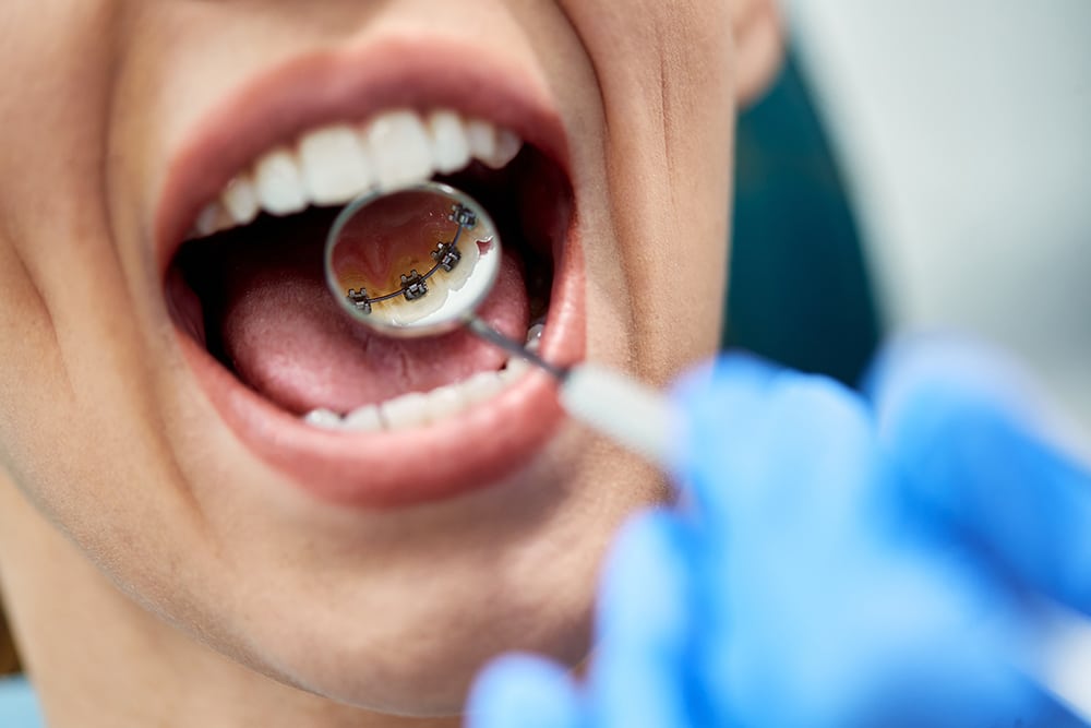 Close-up of a dental mirror reflecting Inbrace lingual braces placed on the back of teeth, with a gloved hand holding the mirror