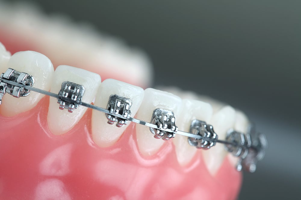 Close-up of traditional metal braces on teeth, showcasing brackets and an archwire