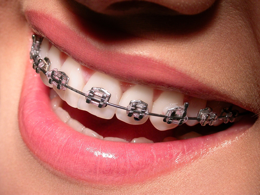 Close-up of teeth with LightForce custom clear braces and a metal archwire