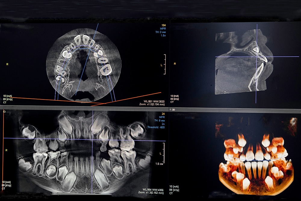 CBCT dental scan showing 3D and cross-sectional views of teeth, jaws, and surrounding structures for detailed orthodontic analysis