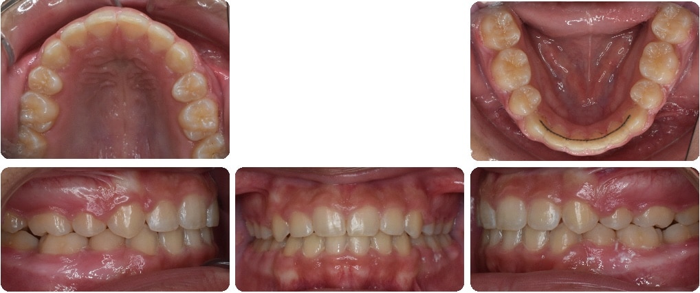 After images of Case #1 showing corrected Class I Malocclusion and resolved crowding, with upper, lower, and side views