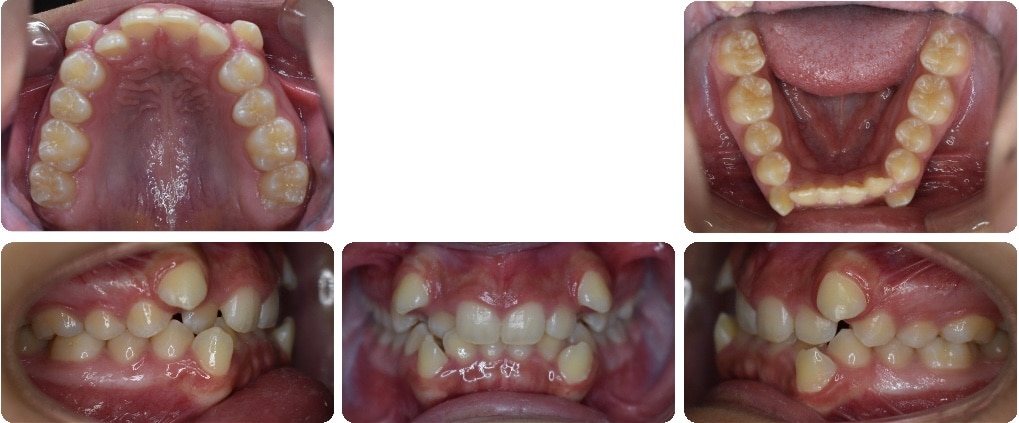 Before images of Case #1 showing Class I Malocclusion and severe crowding, with upper, lower, and side views of teeth alignment