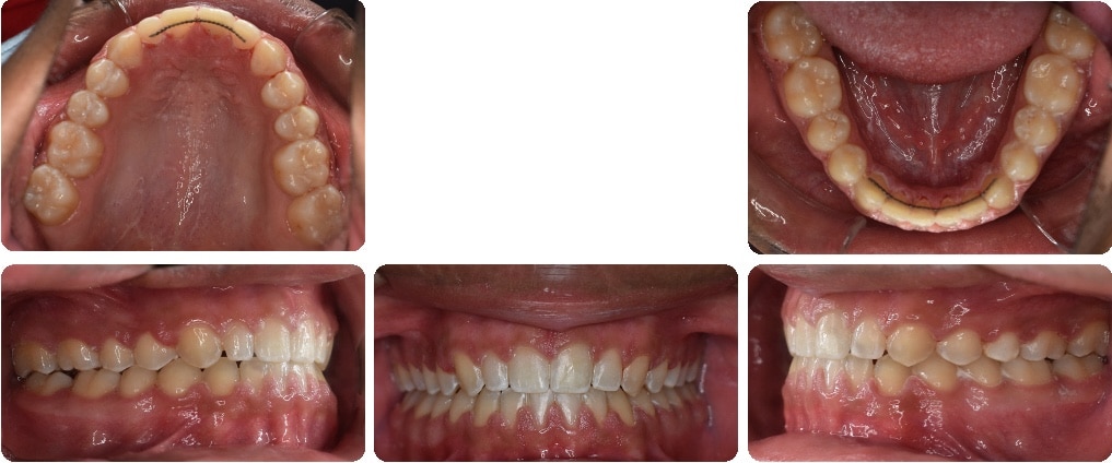 After images of Case #2 showing corrected Malocclusion, spacing, and tongue thrust with full views