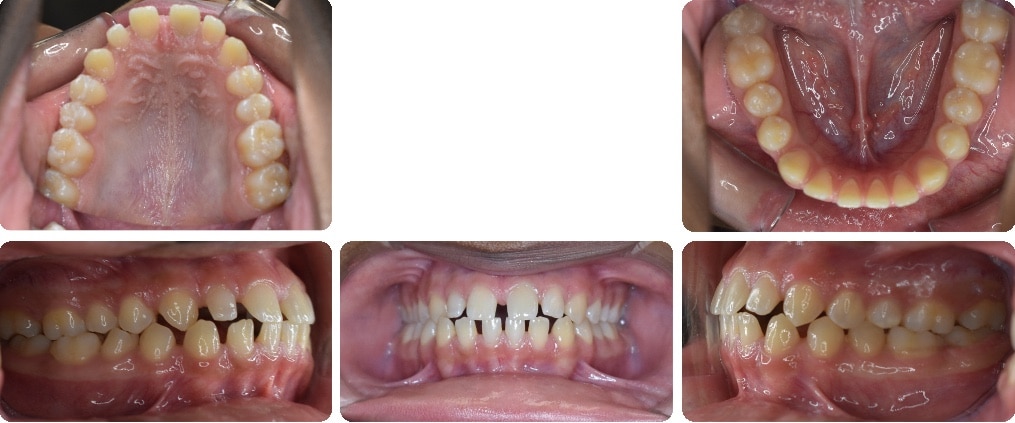 Before images of Case #2 showing Class I Malocclusion, spacing, and tongue thrust, with upper, lower, and side views