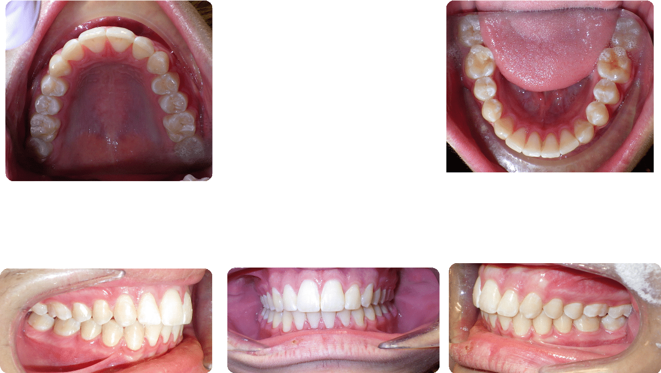 After images of Case #3 showing corrected Class II Malocclusion, deep bite, and crowding with full views