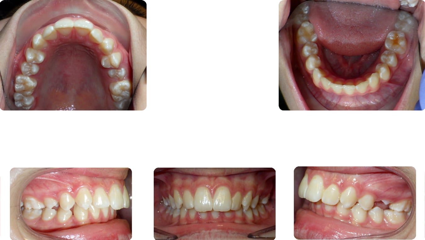 Before images of Case #3 showing Class II Malocclusion, deep bite, and mild crowding with full views