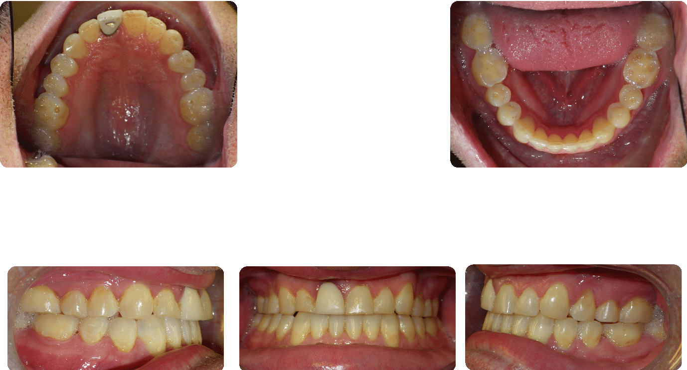 After images of Case #4 showing corrected Class III Malocclusion and crossbite, including full views