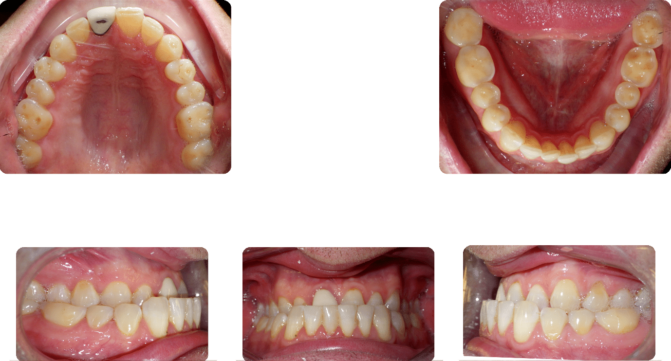 Before images of Case #4 showing Class III Malocclusion with crossbite, including full views