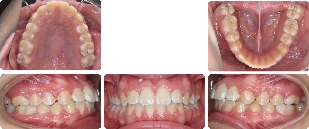 After images of Case #5 showing corrected Class III Malocclusion and resolved moderate crowding with full views