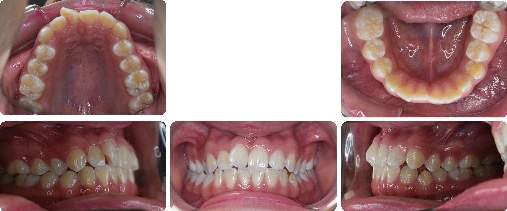 Before images of Case #5 showing Class III Malocclusion and moderate crowding with full views