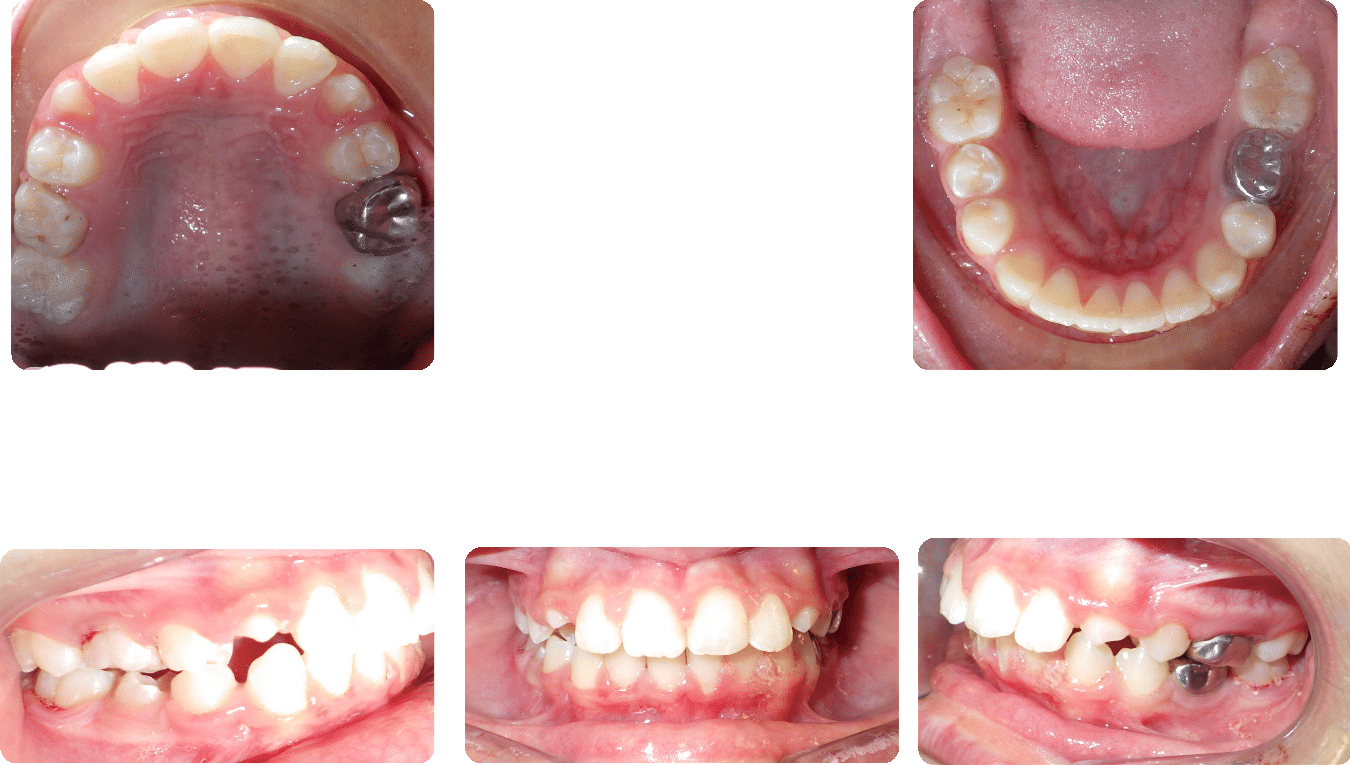 After images of Case #6 showing Phase I treatment, corrected crossbite, and resolved crowding