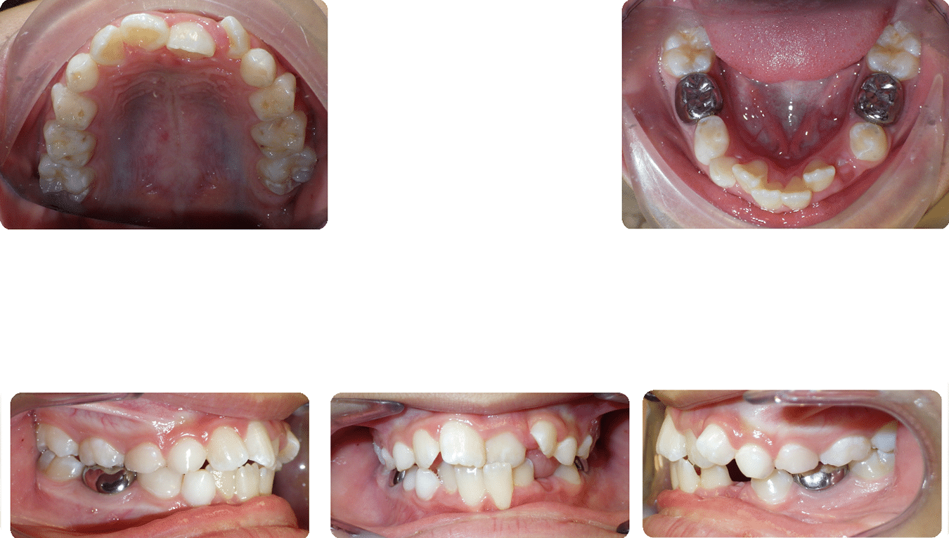 Before images of Case #6 showing Phase I treatment, crossbite, and moderate crowding with full views