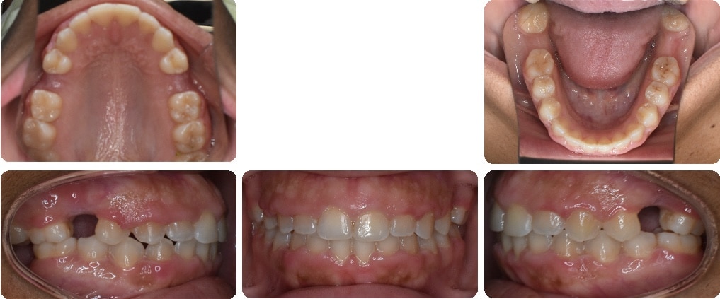 After images of Case #7 showing corrected bite and improved tongue thrust habit