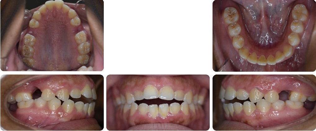 Before images of Case #7 showing Class I Malocclusion, anterior open bite, and tongue thrust habit with full views