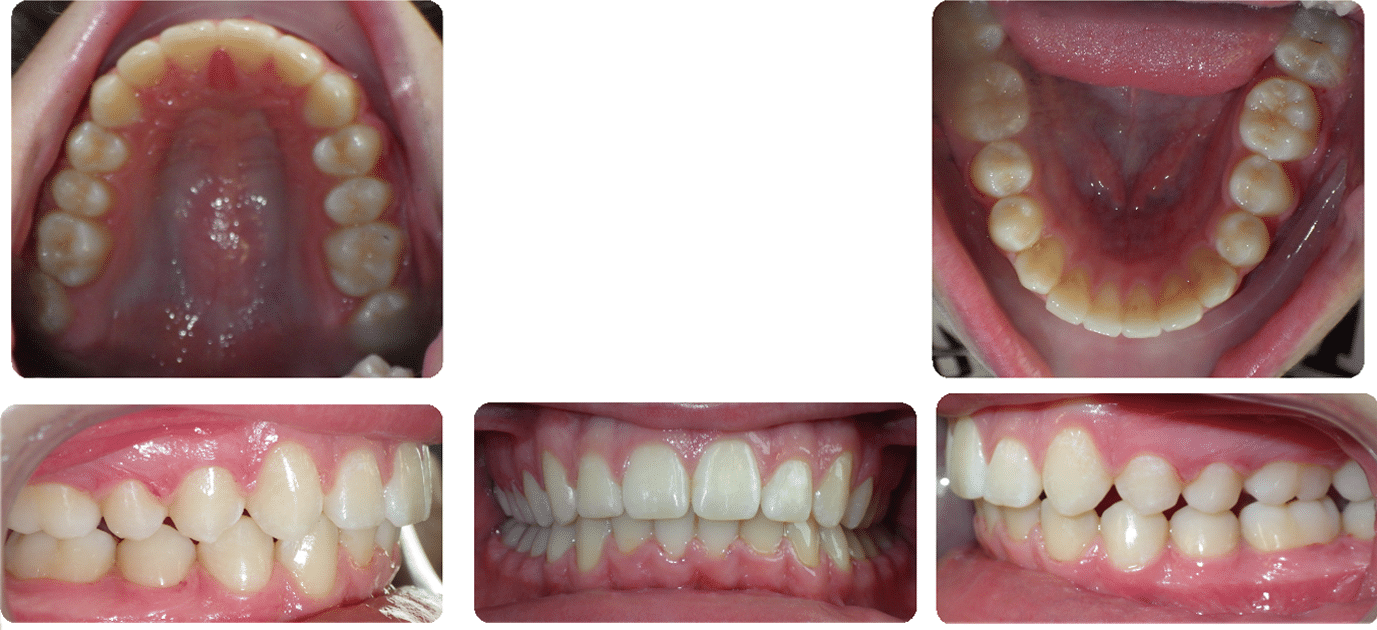 After images of Case #8 showing corrected Class II Division I Malocclusion, reduced overjet, and resolved deep bite with full views