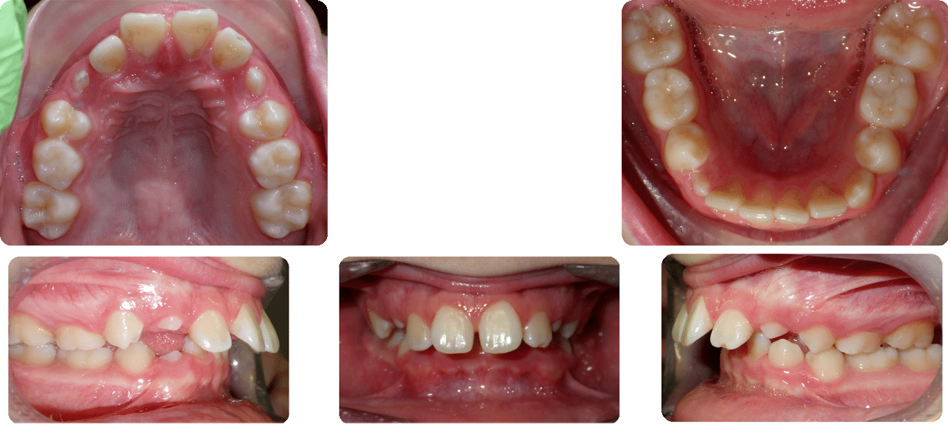 Before images of Case #8 showing Class II Division I Malocclusion, excess overjet, and deep bite with full views