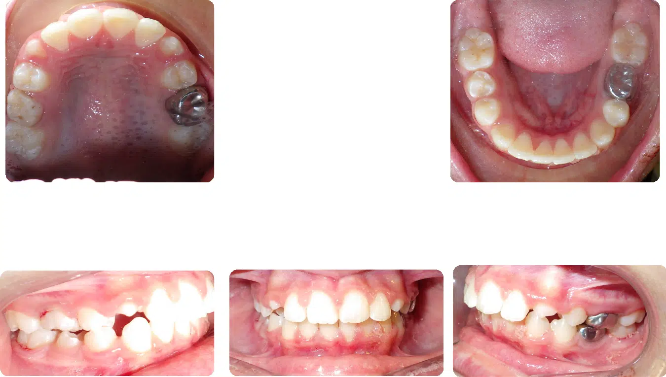 Smile Gallery | Movement Orthodontics in Centennial & Aurora
